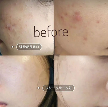 堪稱“換臉”的神奇煥膚術，你get了嗎？