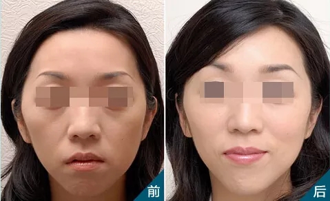 無針水光，憑什么讓女性為之瘋狂和傾倒？！