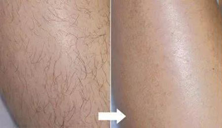 春季不脫毛，夏季獼猴桃！現(xiàn)在是脫毛的 佳時機(jī)~