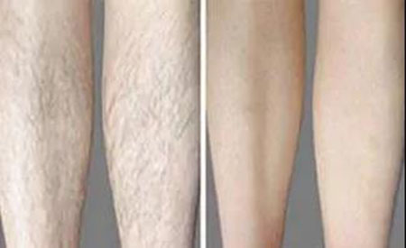 春季不脫毛，夏季獼猴桃！現(xiàn)在是脫毛的 佳時機(jī)~