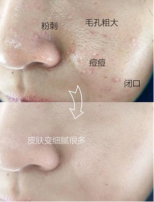 被粉刺、黑頭、毛孔、角質(zhì)糾纏？千萬(wàn)別忽視深層清潔！