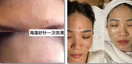 排出炎癥,治愈痘痘粉刺